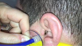 Removing Dark EAR WAX without Tools [upl. by Ettennej]