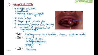 Epulis  Types Clinical Features Treatment  Surgery  Dr Shankar Dey [upl. by Cornell518]