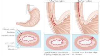 USMLE S2CK Uworld case no 33Boerhaave syndrome [upl. by Assert]