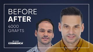 Hair Transplant in Turkey  Hair Transplant Results of Cosmedica [upl. by Asiram]