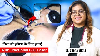 How to Get Rid of Moles on Skin  Remove Facial Moles Permanently with Fractional CO2 Laser [upl. by Damicke]