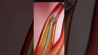 Heart Surgery Animated Guide to Angioplasty [upl. by Ardnuas]