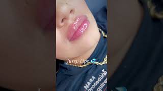 Hyaluron Pen Lips Needle free lip fillers using dermalax deep plus [upl. by Denna]