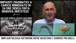 Implantologia Dentale  Prezzi Costi Intervista Angiolino [upl. by Yate]