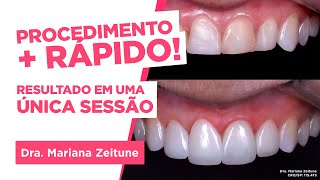 TRANSFORME SEU SORRISO Facetas e lentes de contato em resina composta Saiba tudo [upl. by Bahr]