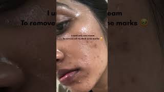 Acne scar removal with just one cream🫢♥️ shorts acne acnetreatment skincare skincareroutine [upl. by Notsirb900]