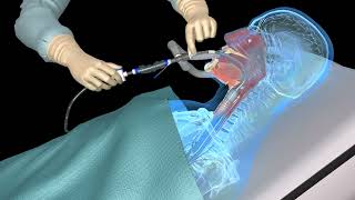 Suctioning the endotracheal tube  medical animation [upl. by Analem]