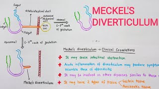 Meckels Diverticulum With Clinical Correlations [upl. by Gereron411]