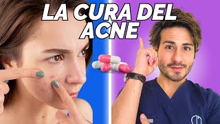 ACNE esta es la verdadera Cura [upl. by Charry]