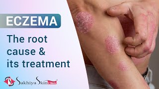 Eczema  Root Causes amp Treatment  How to get rid of Eczema  DrJagdish Sakhiya  In Hindi [upl. by Naellij]