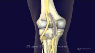 Peroneal and Tibial Intraneural Ganglion Cysts in the Knee Region Video 2 [upl. by Muller747]