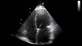 Restrictive Cardiomyopathy [upl. by Doubler]