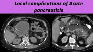 Local complications of acute pancreatitis [upl. by Rehttam732]