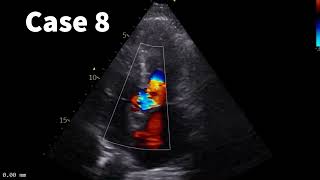 Color Doppler Echo quiz improve your skill to identify with the help of color Doppler in 4 minutes [upl. by Hoskinson23]