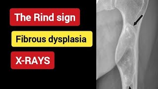 Fibrous dysplasia  The Rind Sign  Basic Radiology [upl. by Radman]