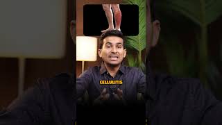 Cellulitis  Dr B Padam Kumar [upl. by Sac531]