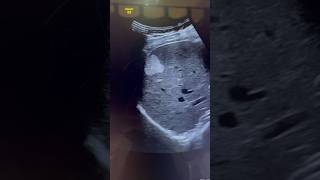 Hemangioma Ultrasound  Liver Mass sonography  ARDMS  Radiology Sonographer [upl. by Ehav316]