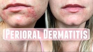 Perioral Dermatitis How I treated it [upl. by Scribner]