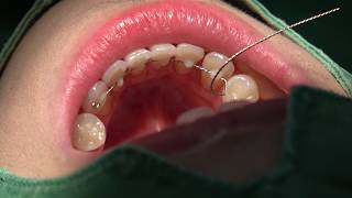 Bonded lingual fixed retainer in 10 min [upl. by Yetnom]