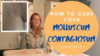 Molluscum Contagiosum How to cure it Naturally with Apple Cider Vinegar [upl. by Steffy35]