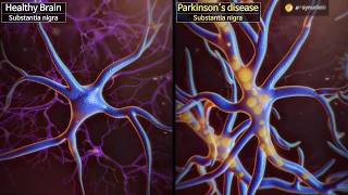 Wake up dormant dopaminergic neurons to reverse Parkinson’s disease [upl. by Lleder]