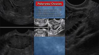 Polycystic Ovaries PCOs 💯❤️ polycysticovarysyndrome ovary pregnancy medical ultrasound health [upl. by Yadnus]