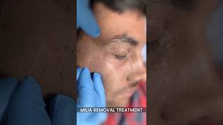 Milia Removal Treatment at Skinaa Clinic viral shorts shortsfeed [upl. by Kyrstin]