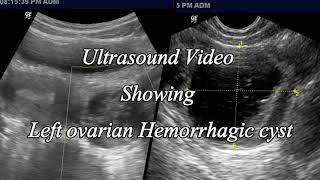 Ovarian Hemorrhagic Cyst Ultrasound [upl. by Enrobyalc]