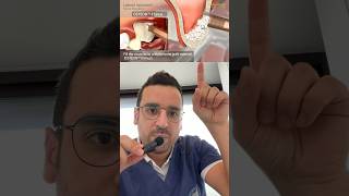 GREFFE dentaire  le clé du sinus lift avec implant [upl. by Kendall264]