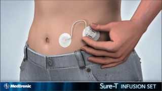 How to insert the Medtronic MiniMed SureT infusion set  diabetes therapy [upl. by Marlon]