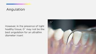 Optimize Your Cavitron Technology Cavitron® Thinsert® Insert [upl. by Zoba536]