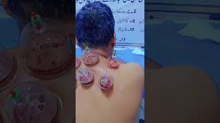 Hijama sunat bi ilaj bi health hijama [upl. by Ofella]