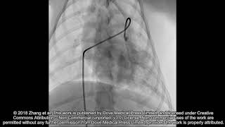 Thrombolytic effect of bolus administration of reteplase  180151 [upl. by Riaj]