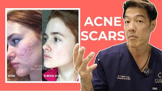 The Best Acne Scar Treatments Explained  Dr Davin Lim [upl. by Orren]