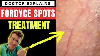 How to treat FORDYCE SPOTS  Doctor ODonovan explains [upl. by Acnairb]