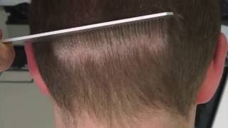 Donor Area  FUE 6 weeks Post Op  HRBR  Hair Restoration Blackrock [upl. by Samoht]