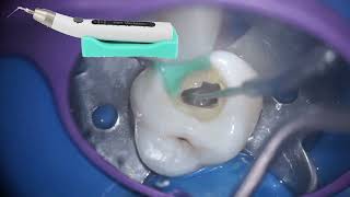 Managing a Calcified Maxillary Molar with ultrasonics [upl. by Dehsar]