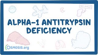 Alpha1 Antitrypsin Deficiency  causes symptoms diagnosis treatment pathology [upl. by Anallese]