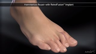 Hammertoe Repair with RetroFusion™ Implant [upl. by Acirederf]