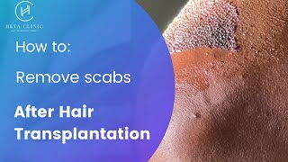 How to Get Rid of Scabs After Hair Transplant  Heva Clinic [upl. by Fullerton476]