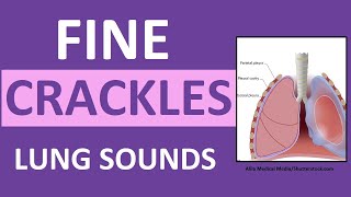 Crackles Fine Lung Sounds  Crackles and Rales Breath Sounds Abnormal [upl. by Otrebtuc]