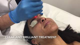 Dr Patel performs a Clear  Brilliant Permea gentle laser treatment  Miami FL [upl. by Anamuj]