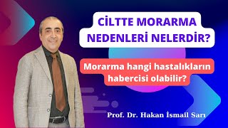 Ciltte Morarma Nedenleri Nelerdir  Hangi Rahatsızlıklar Morarmaya Neden Olur [upl. by Eidarb]