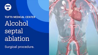 Alcohol Septal Ablation Surgical Procedure for Hypertrophic Cardiomyopathy HCM  Tufts Medicine [upl. by Iams]