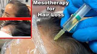 Mesotherapy for hair loss amazing results Before and after photos post 4th session [upl. by Llewop]