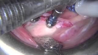 Short implants and mucoderm soft tissue graft in mandible miniinvasive treatment [upl. by Dorfman]