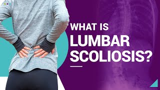 What Is Lumbar Scoliosis [upl. by Devon]