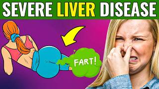 17 SIGNS that your LIVER is DYING  DANGEROUS [upl. by Wilburt]