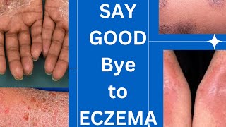 Management guidelines of eczema skin specialist advice How to treat eczemaskinhealthvitality5959 [upl. by Civ]