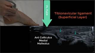 Deltoid Ligament Ultrasound 2023 [upl. by Silverstein618]